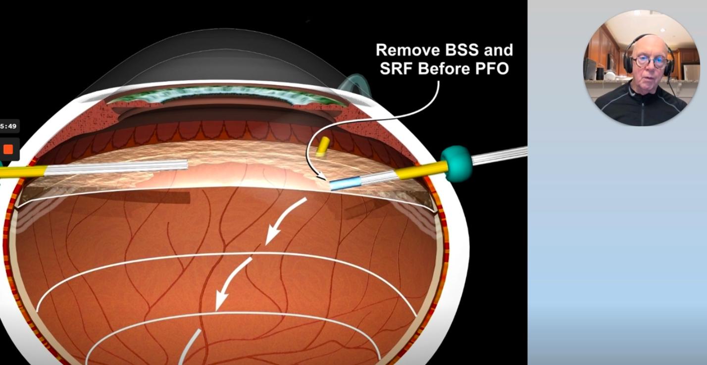 Medium Term Pfo For Inferior Retinal Detachments And Giant Retinal